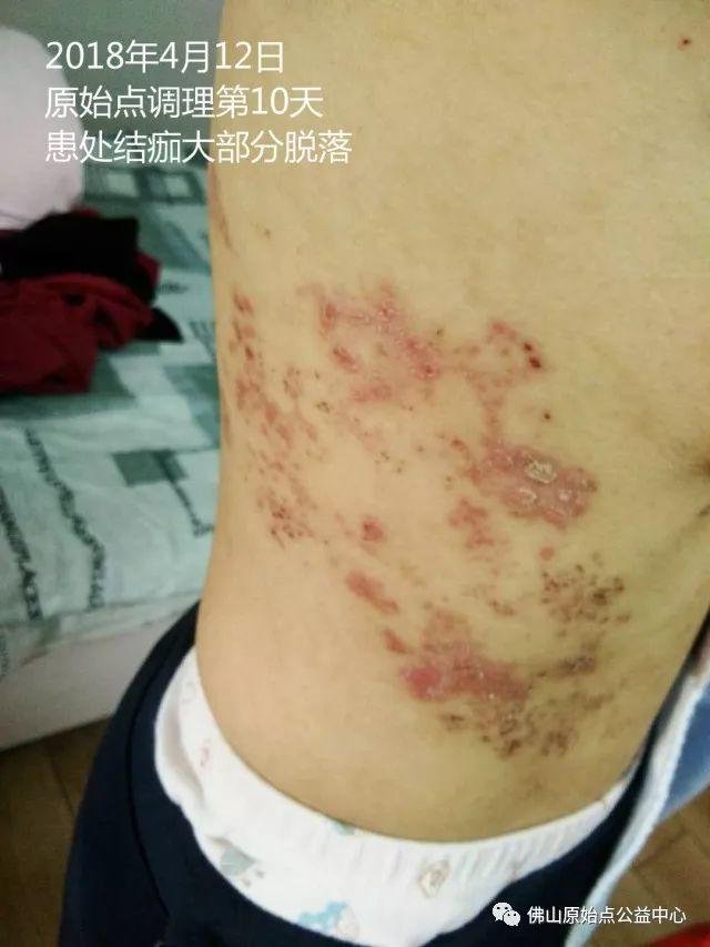 原始点调理带状疱疹：12天恢复+意外收获