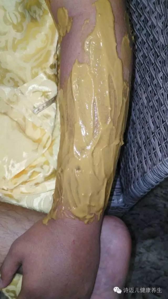 案例分享：原始点调理蛇毒的成功案例