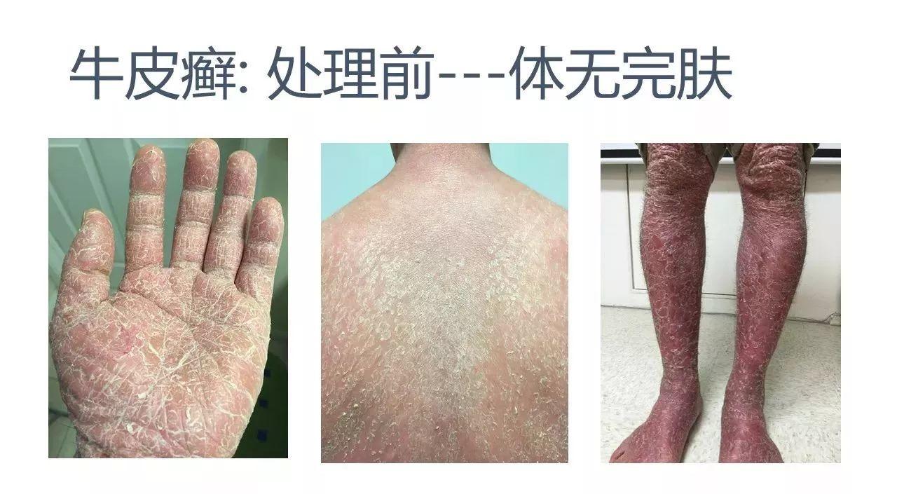 牛皮癣案例(日本人)(后续追踪)-七不姜 生姜养生网-明德CSA生态姜园&明安农业