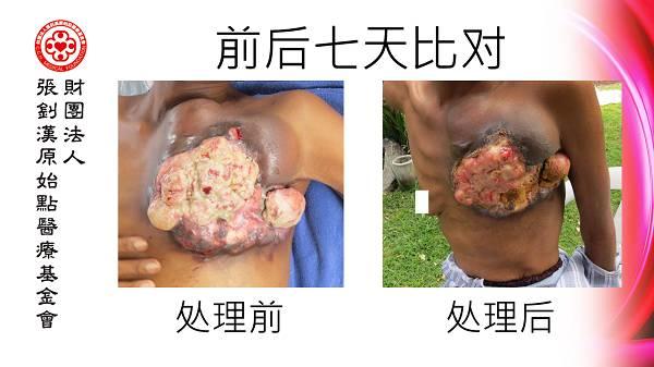 乳癌七天大幅改善案例（46岁辛巴威）（简体版）