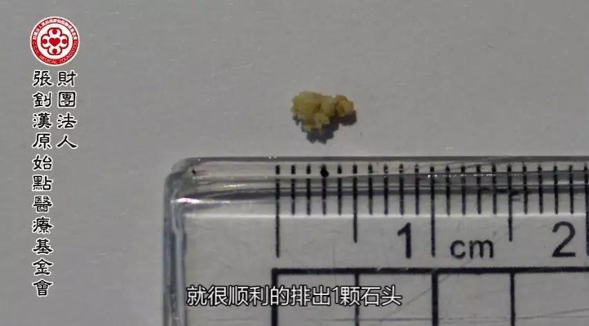 结石自然排出案例-2017.8最新案例-七不姜 生姜养生网-明德CSA生态姜园&明安农业