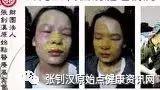 脸部烫伤案例(山东女孩)-七不姜 生姜养生网-明德CSA生态姜园&明安农业