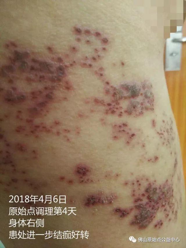 原始点调理带状疱疹：12天恢复+意外收获