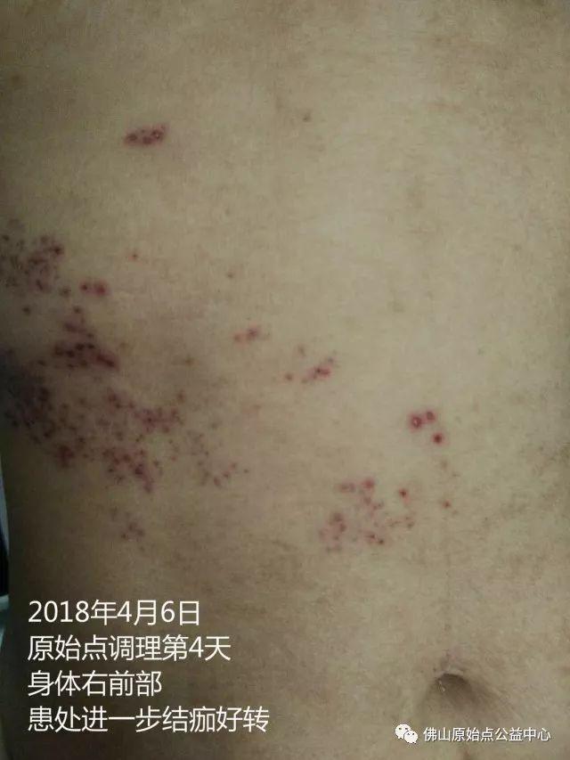 原始点调理带状疱疹：12天恢复+意外收获