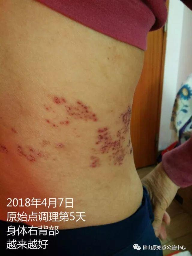 原始点调理带状疱疹：12天恢复+意外收获