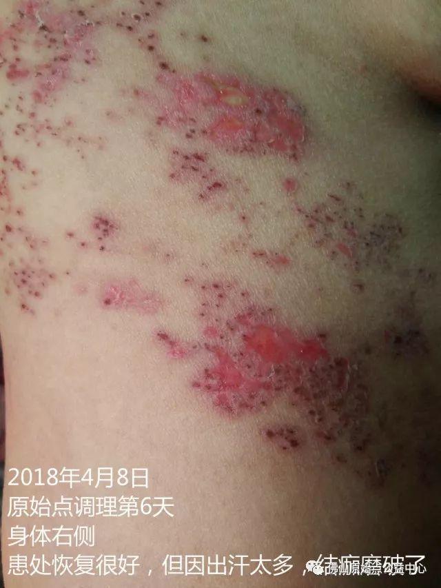 原始点调理带状疱疹：12天恢复+意外收获