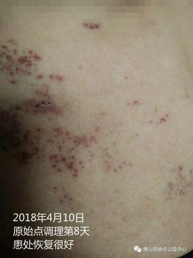 原始点调理带状疱疹：12天恢复+意外收获