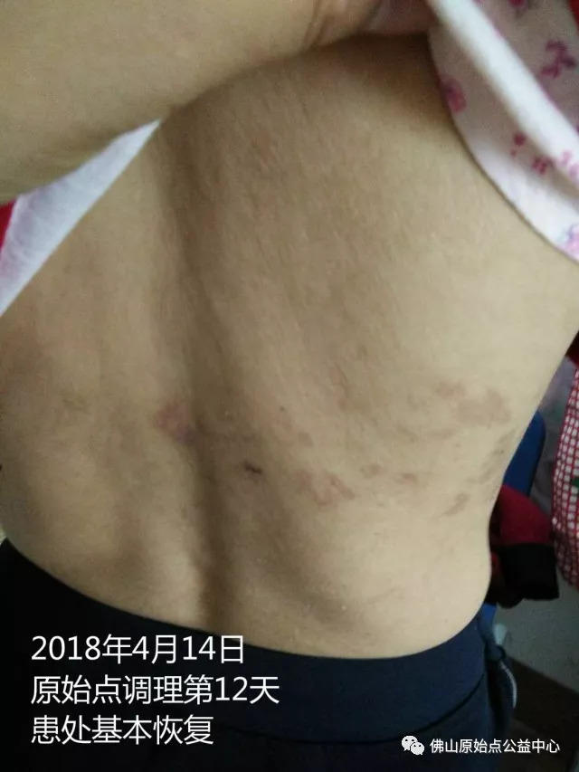 原始点调理带状疱疹：12天恢复+意外收获