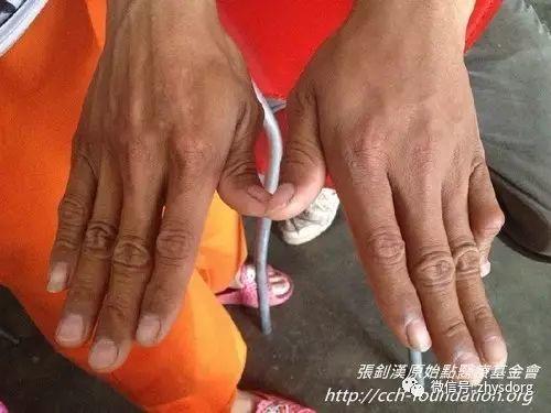 [經驗分享] 原始點應用分享-處理虎頭蜂螫傷