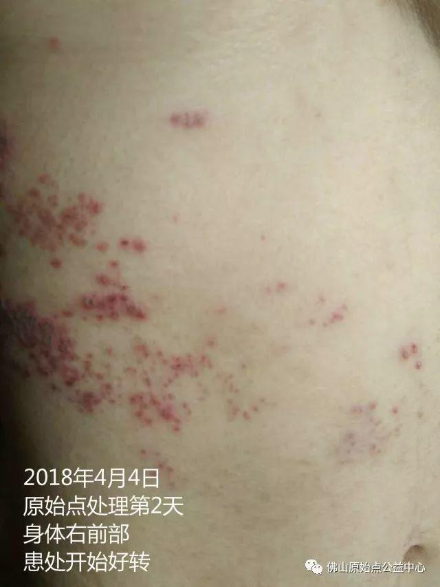 原始点调理带状疱疹：12天恢复+意外收获