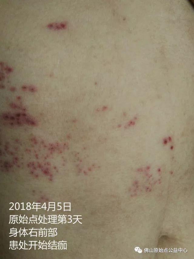 原始点调理带状疱疹：12天恢复+意外收获
