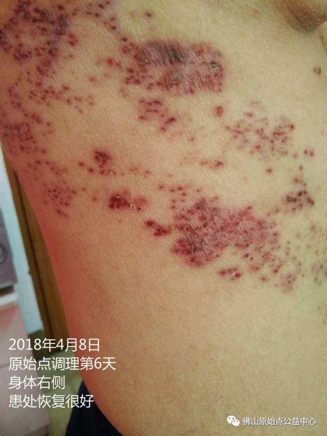 原始点调理带状疱疹：12天恢复+意外收获