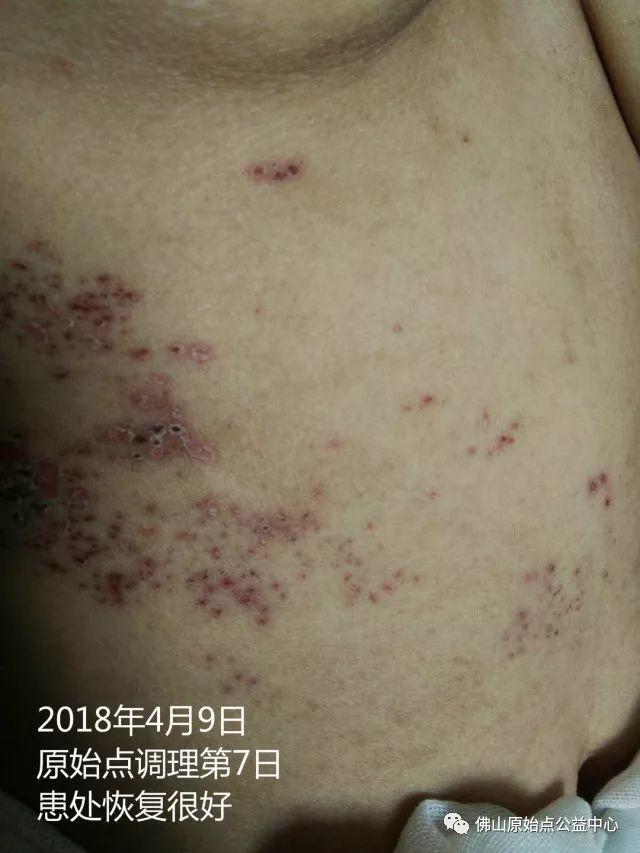 原始点调理带状疱疹：12天恢复+意外收获