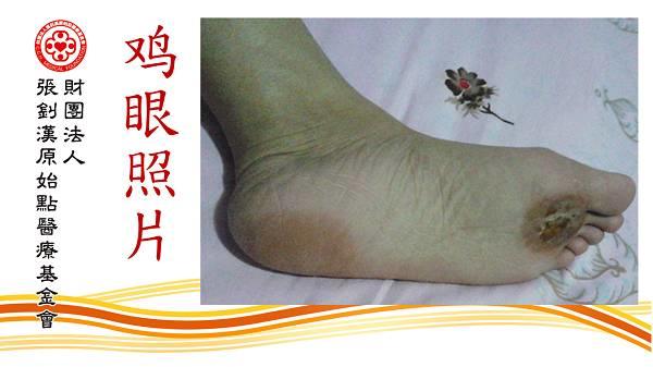 鸡眼用原始点处理9天痊愈案例（简体版）