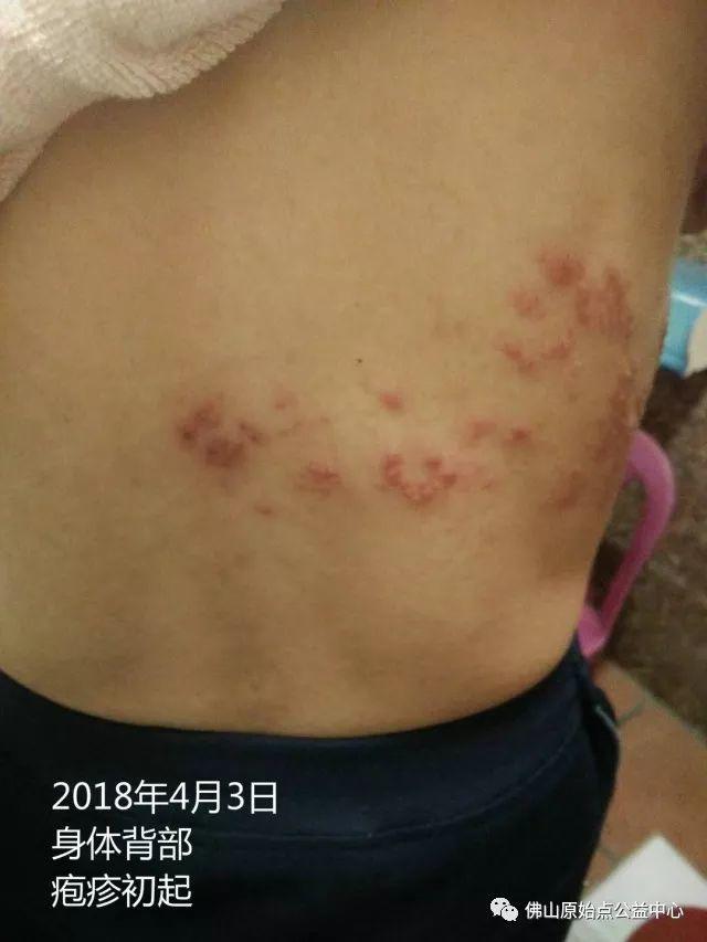 原始点调理带状疱疹：12天恢复+意外收获