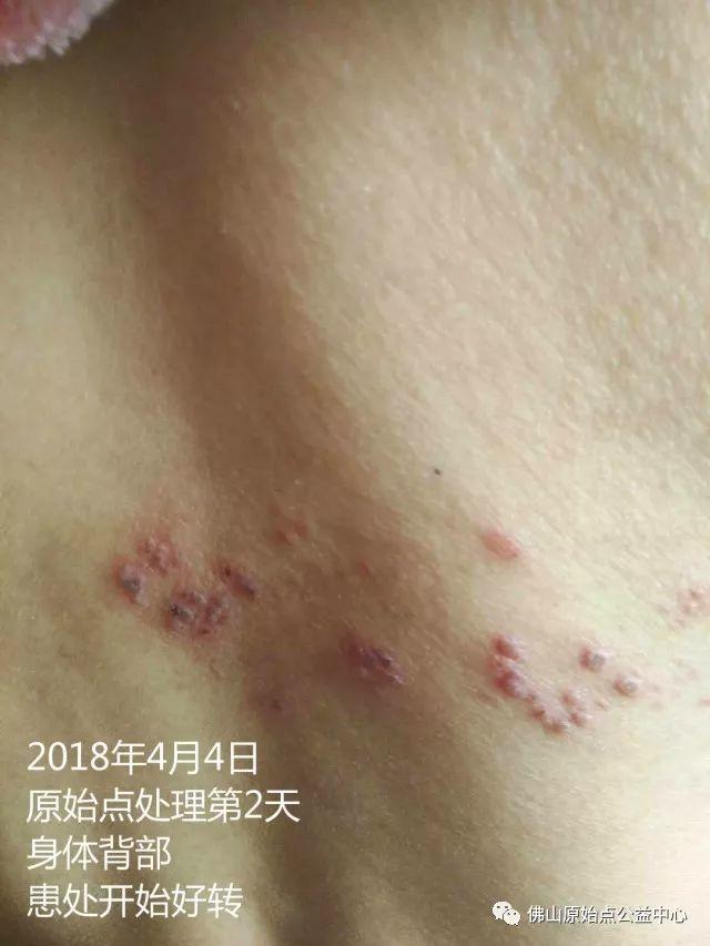 原始点调理带状疱疹：12天恢复+意外收获