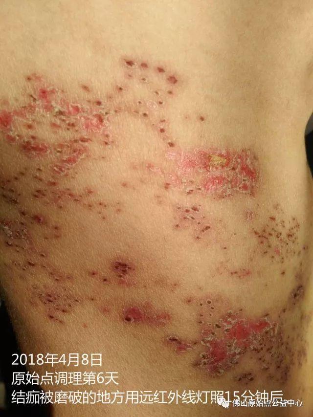 原始点调理带状疱疹：12天恢复+意外收获