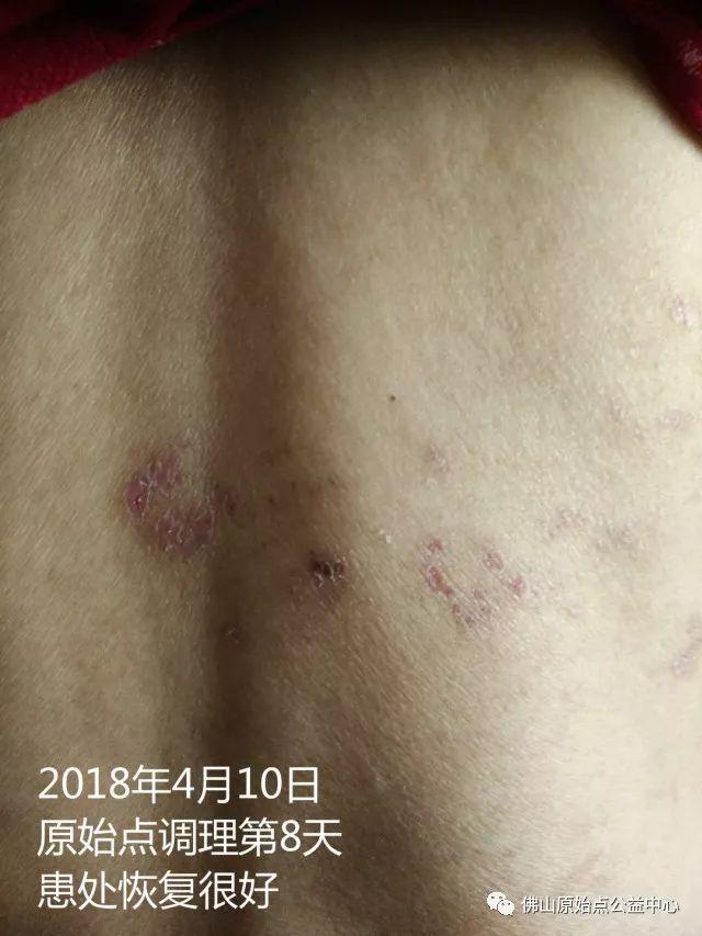 原始点调理带状疱疹：12天恢复+意外收获