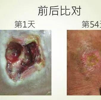 脚部伤口案例（简体版）-七不姜 生姜养生网-明德CSA生态姜园&明安农业