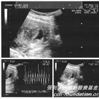 胎死腹中案例(台湾)(简体版)-七不姜 生姜养生网-明德CSA生态姜园&明安农业