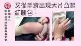 皮肤病案例(女童)-2017.7最新案例-七不姜 生姜养生网-明德CSA生态姜园&明安农业