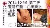 手部烫伤案例(旧金山)-七不姜 生姜养生网-明德CSA生态姜园&明安农业