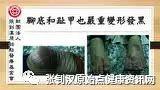 胆管癌案例(旧金山梁先生)-七不姜 生姜养生网-明德CSA生态姜园&明安农业