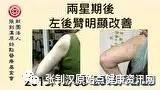 红斑性狼疮案例-七不姜 生姜养生网-明德CSA生态姜园&明安农业