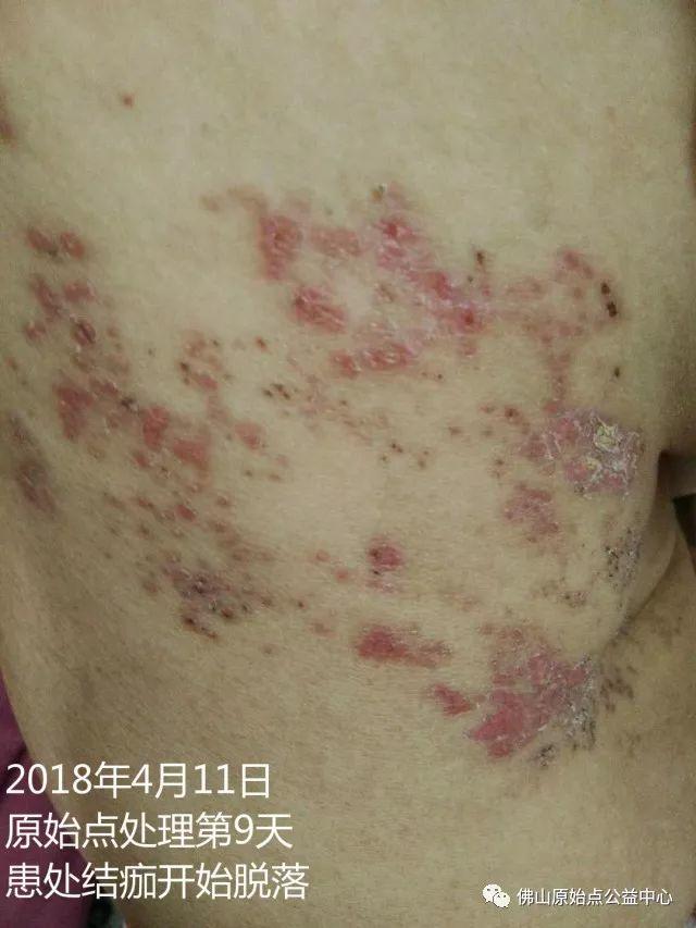 原始点调理带状疱疹：12天恢复+意外收获
