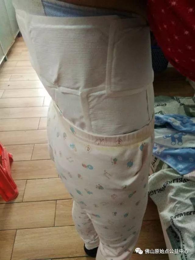 原始点调理带状疱疹：12天恢复+意外收获