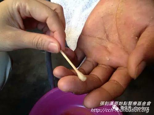 [經驗分享] 原始點應用分享-處理虎頭蜂螫傷