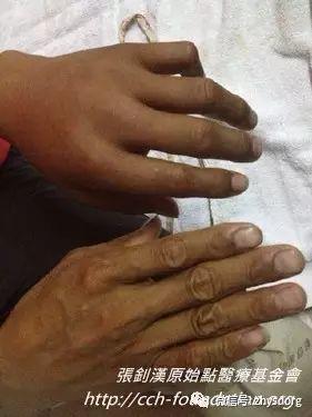 [經驗分享] 原始點應用分享-處理虎頭蜂螫傷