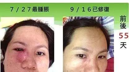 鼻腔恶性淋巴瘤案例-七不姜 生姜养生网-明德CSA生态姜园&明安农业