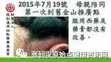 牛皮癣案例(美国女孩)-七不姜 生姜养生网-明德CSA生态姜园&明安农业