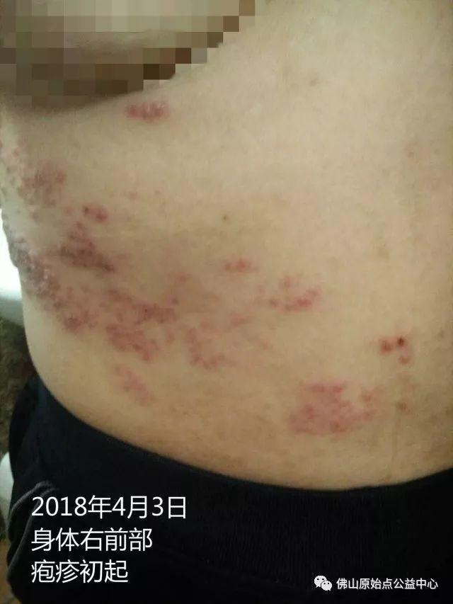 原始点调理带状疱疹：12天恢复+意外收获