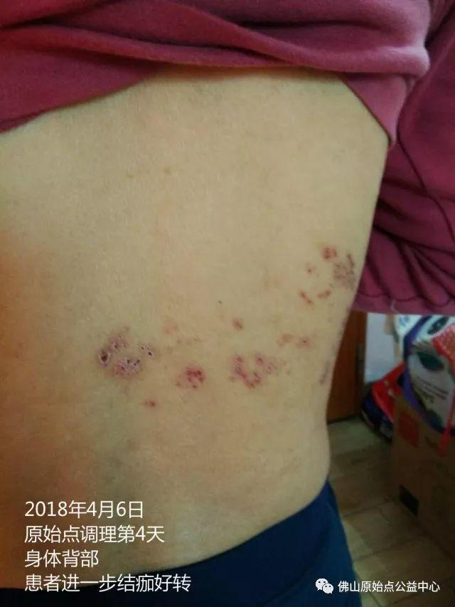 原始点调理带状疱疹：12天恢复+意外收获