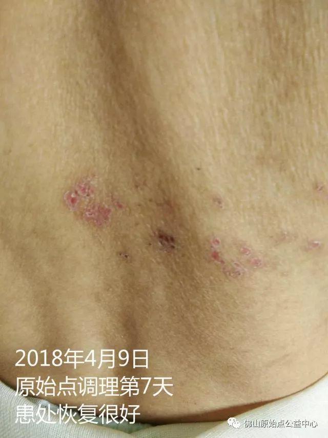原始点调理带状疱疹：12天恢复+意外收获