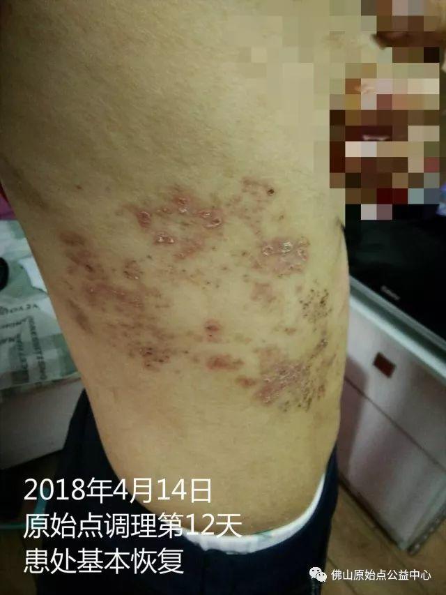 原始点调理带状疱疹：12天恢复+意外收获