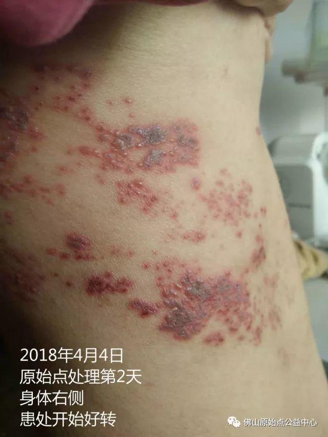 原始点调理带状疱疹：12天恢复+意外收获