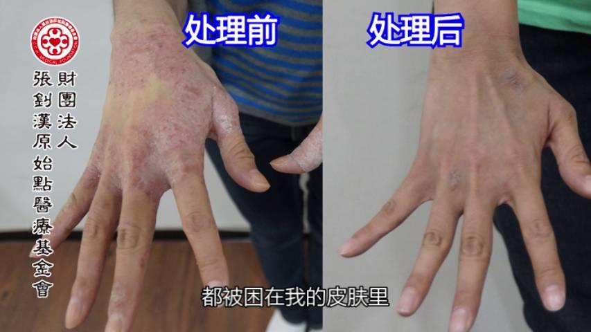 异位性皮肤炎案例(王小姐)（简体版）-2017.8最新案例