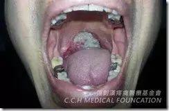 扁桃腺癌案例-七不姜 生姜养生网-明德CSA生态姜园&明安农业