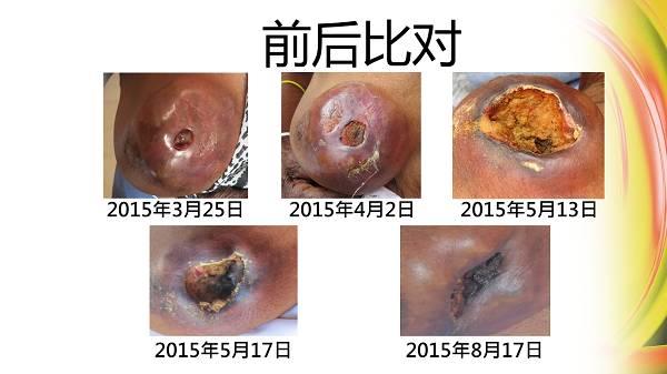 82岁婆婆乳癌案例(简体版)-七不姜 生姜养生网-明德CSA生态姜园&明安农业