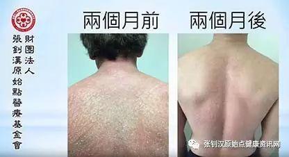 牛皮癣案例(日本人)-七不姜 生姜养生网-明德CSA生态姜园&明安农业