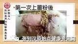 脚烫伤案例(孩童)-七不姜 生姜养生网-明德CSA生态姜园&明安农业