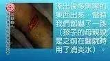 小腿利器划伤案例-七不姜 生姜养生网-明德CSA生态姜园&明安农业