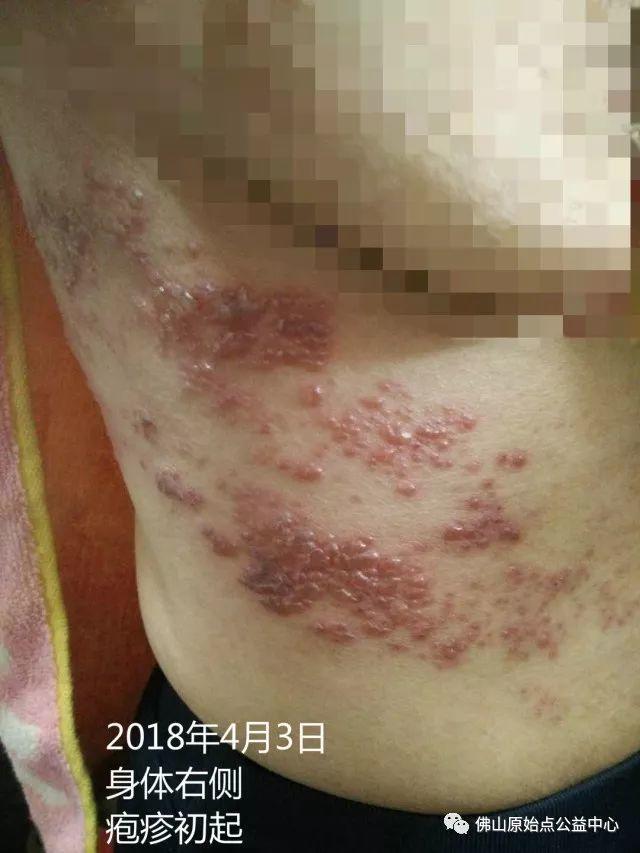 原始点调理带状疱疹：12天恢复+意外收获