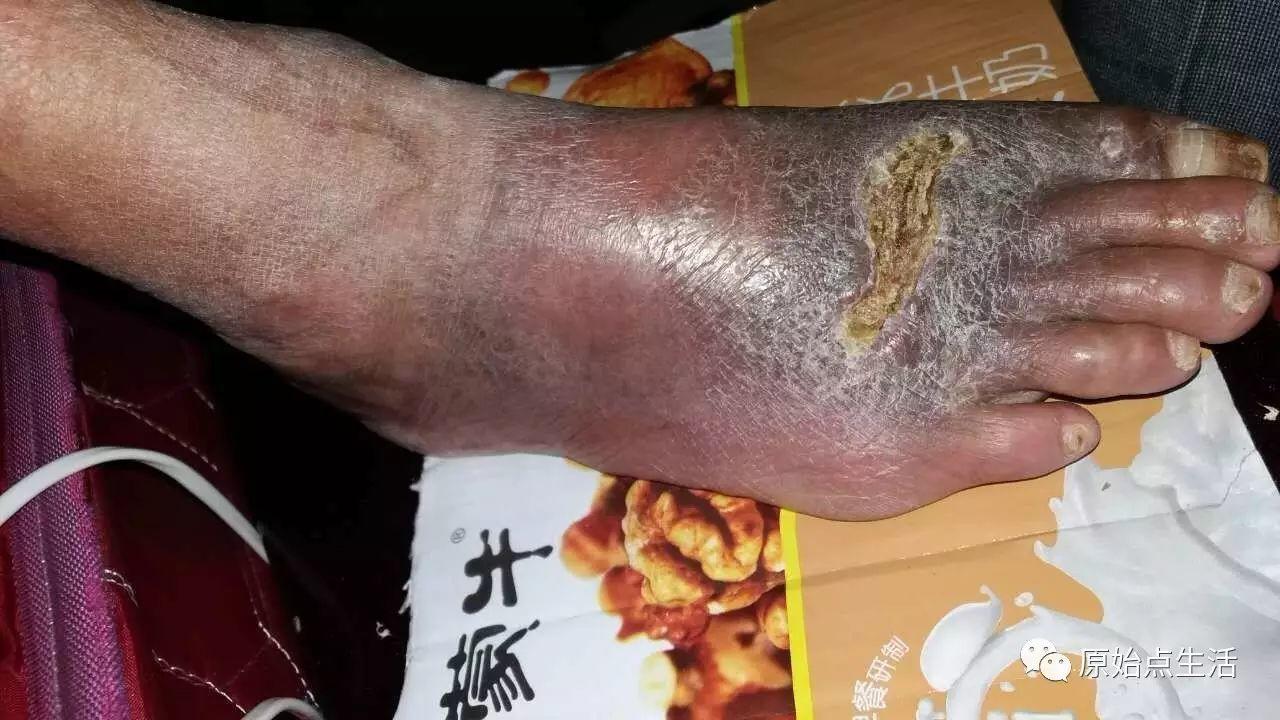 用原始点调理毒蛇咬伤成功案例-七不姜 生姜养生网-明德CSA生态姜园&明安农业