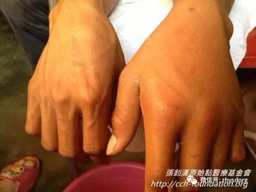 [經驗分享] 原始點應用分享-處理虎頭蜂螫傷