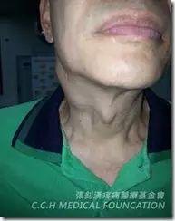 扁桃腺癌案例