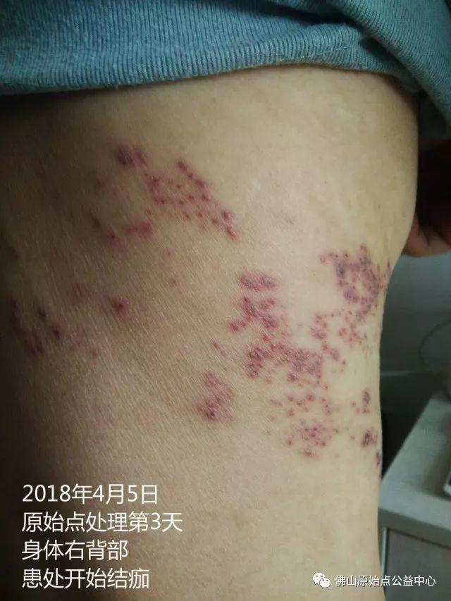 原始点调理带状疱疹：12天恢复+意外收获